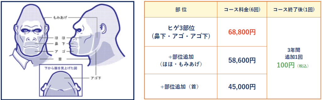 ゴリラクリニックひげ脱毛の料金